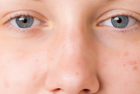 روتين العناية بالبشرة الدهنية: خطوات لضمان بشرة صحية ومتوازنة