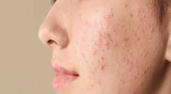 أفضل وصفات لإزالة حب الشباب