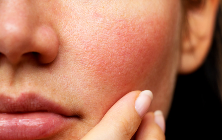 أهمية العناية بالبشرة الحساسة